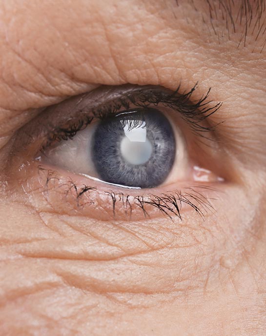 Cataract Eye