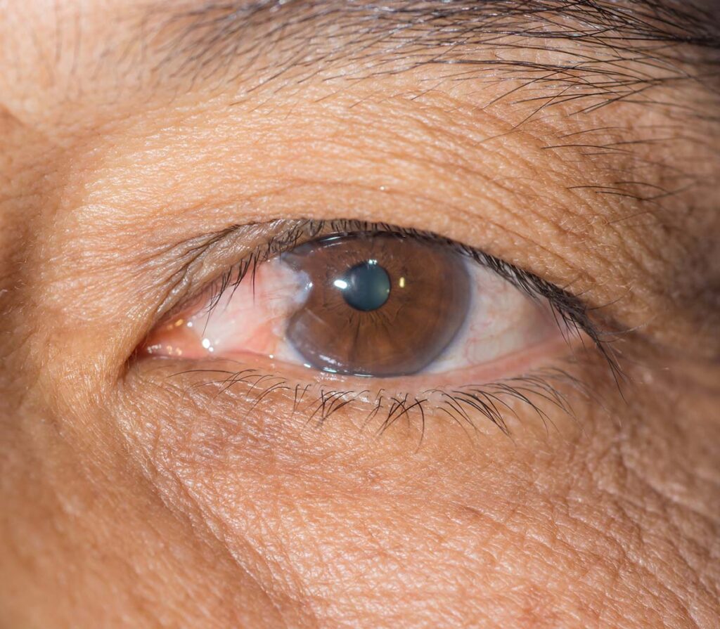 Pterygium