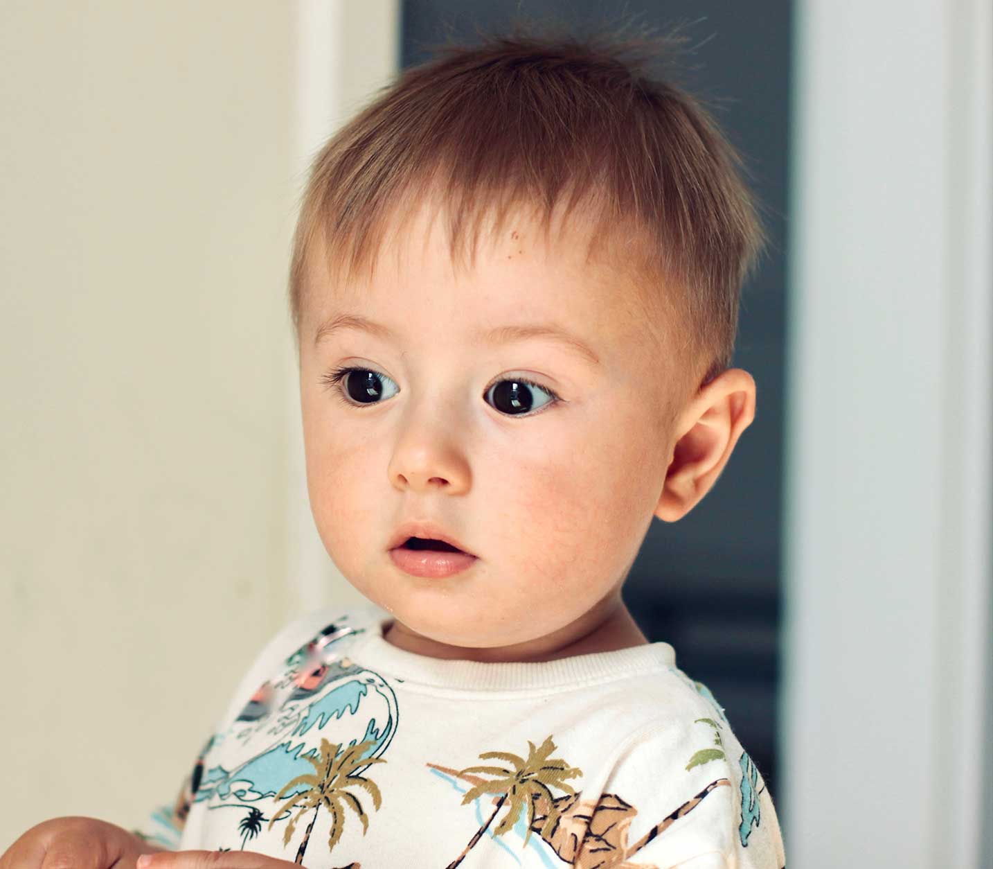Congenital Glaucoma
