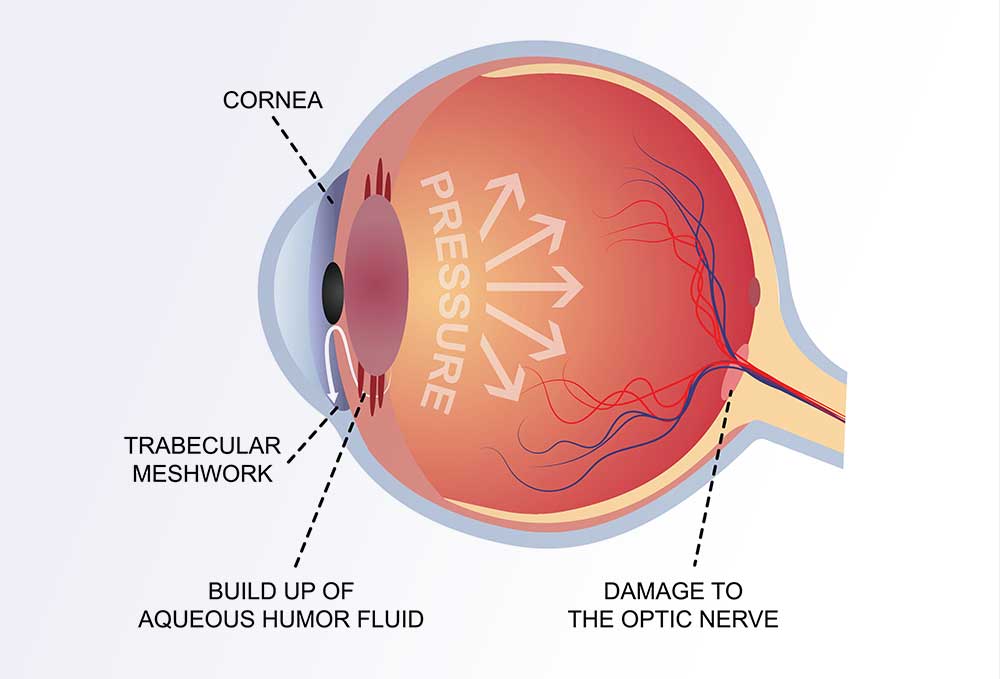 Glaucoma Pressure