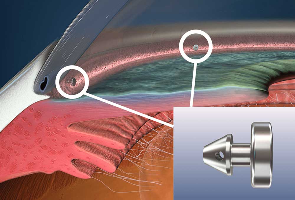 Trabecular Mesh